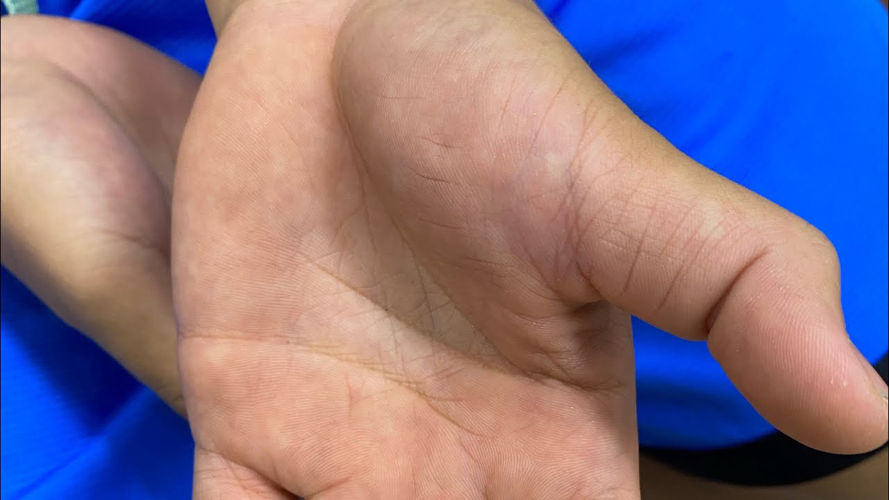 親指脱臼整復