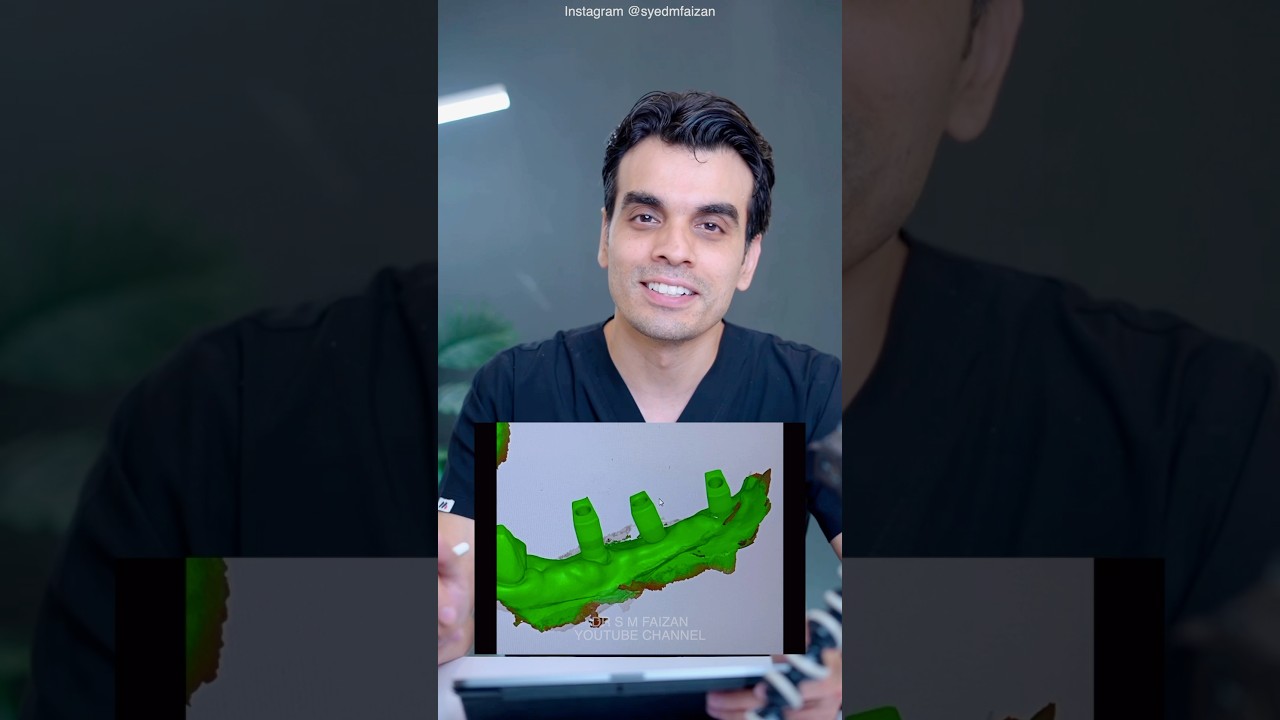 Digital Implant Impression Tip