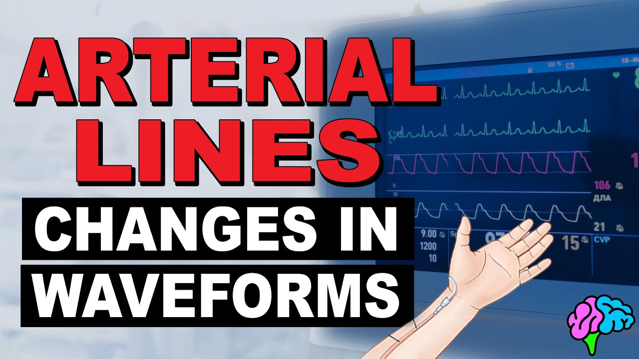 Common Changes in Arterial Line Waveforms