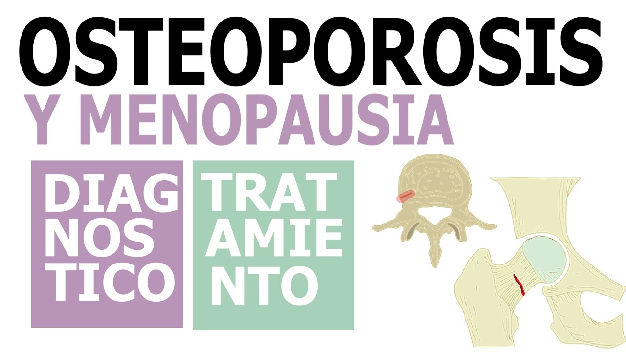 OSTEOPOROSIS en mujeres MENOPAÚSICAS | Evaluación, diagnóstico y tratamiento