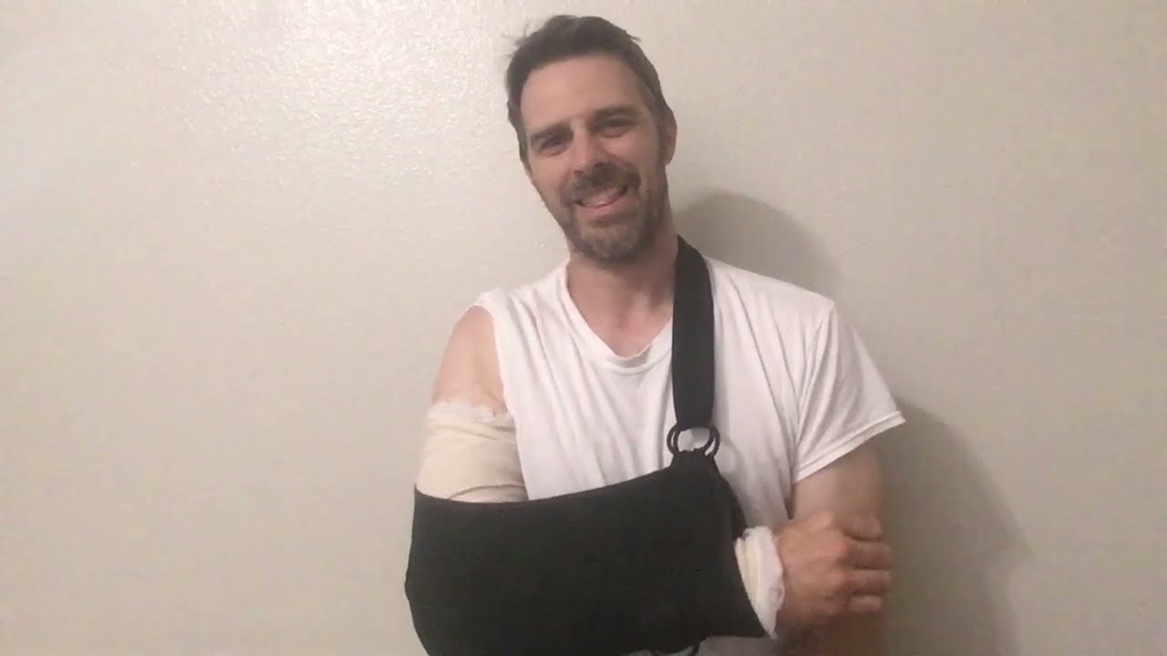 Biceps rupture Day 3 after surgery my second arm distal tendon tear see animation of surgery @ 6:05
