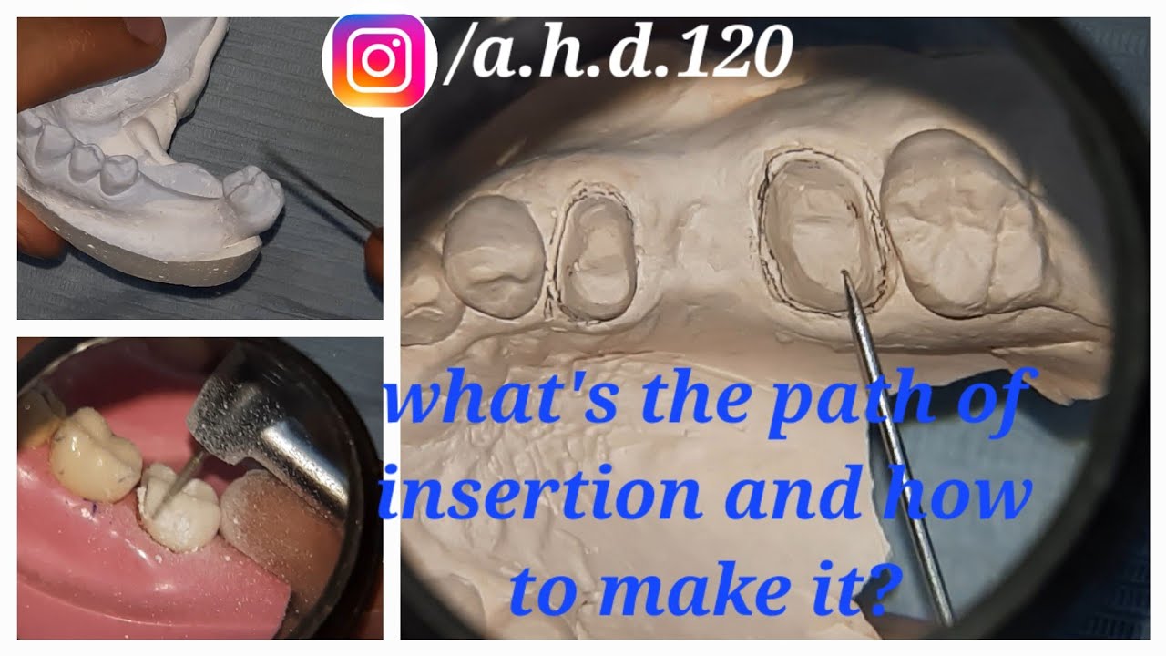 path of insertion & tooth preparation principles (practical عربي)