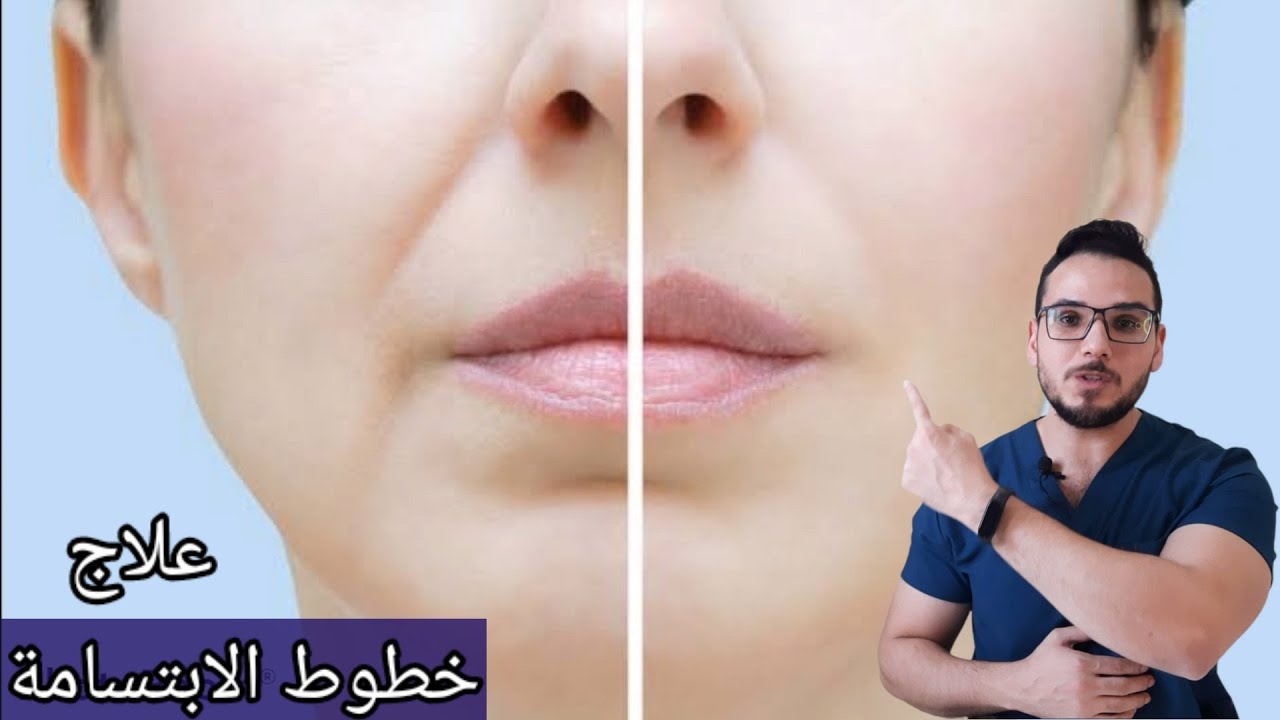 افضل علاج خطوط الابتسامة