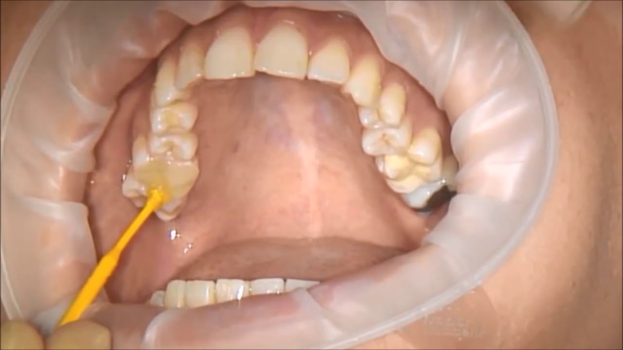 Pinzetta Arti Fol&reg; Bausch per contatti prossimali