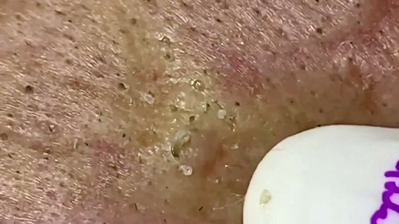 Extreme Blackhead Removal at LNG Skin Care | enilsa brown #74282