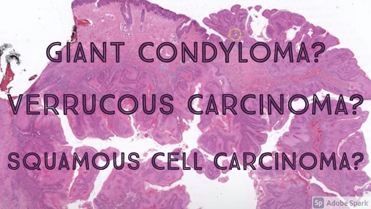 Giant Condyloma vs Squamous Cell Carcinoma vs Verrucous Carcinoma (Dermpath Dermatology Pathology)