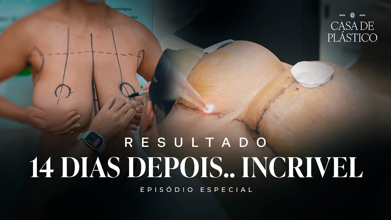 Casa de Plástico: A Verdade Sobre o Pós-Operatório da Mamoplastia Redutora - Cicatriz, Dor, Inchaço