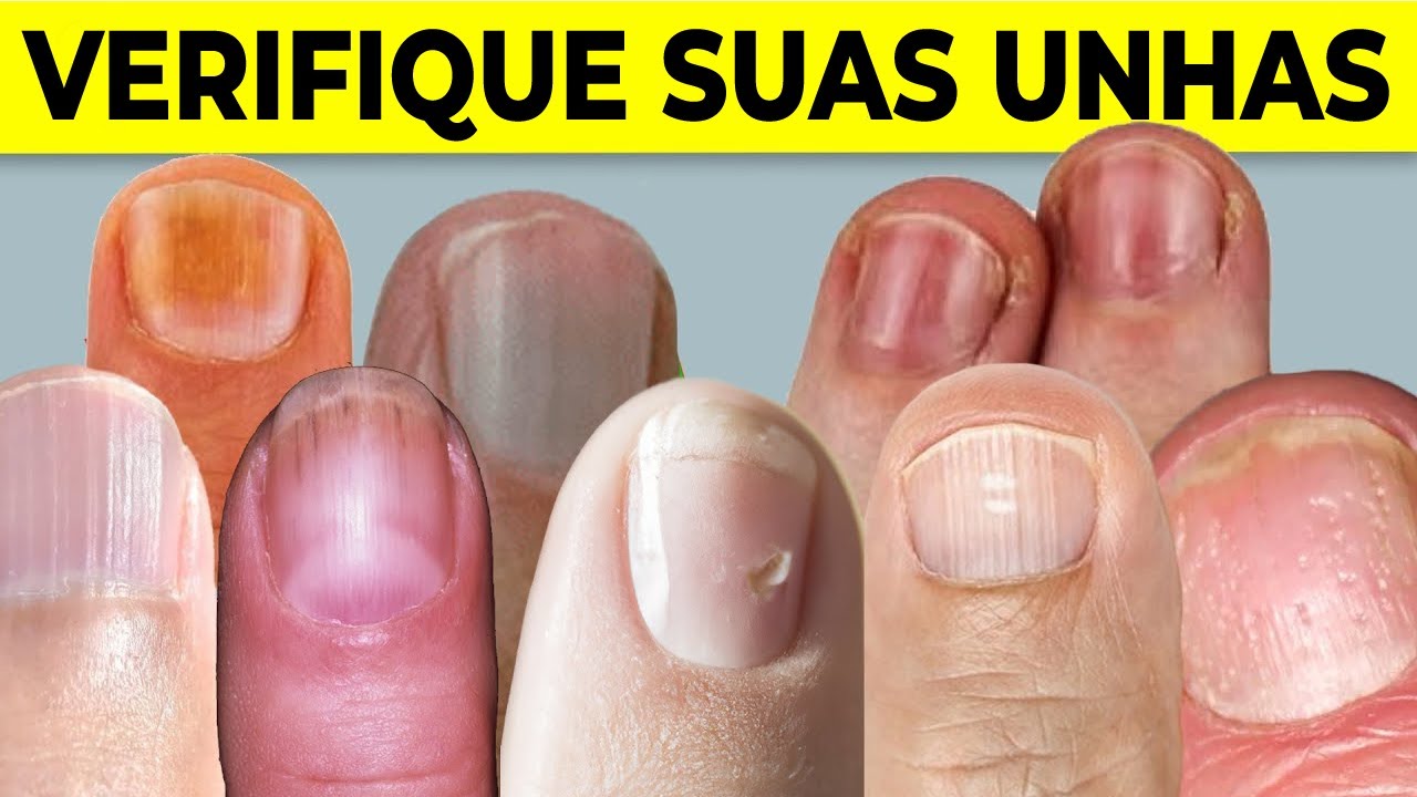 8 Coisas que suas UNHAS Podem Dizer Sobre sua Saúde