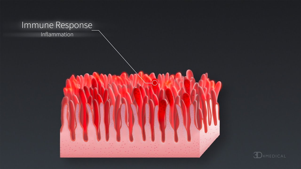 What is Celiac Disease? - World Digestive Health Day