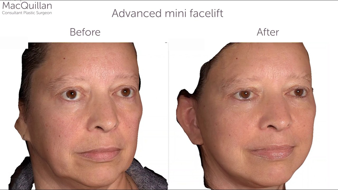 Facelift Before and After