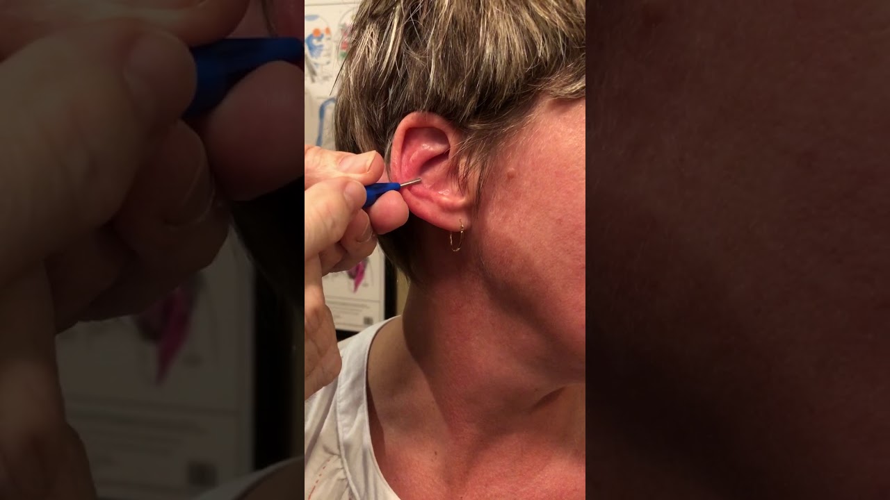 Katherine’s right shoulder treatment