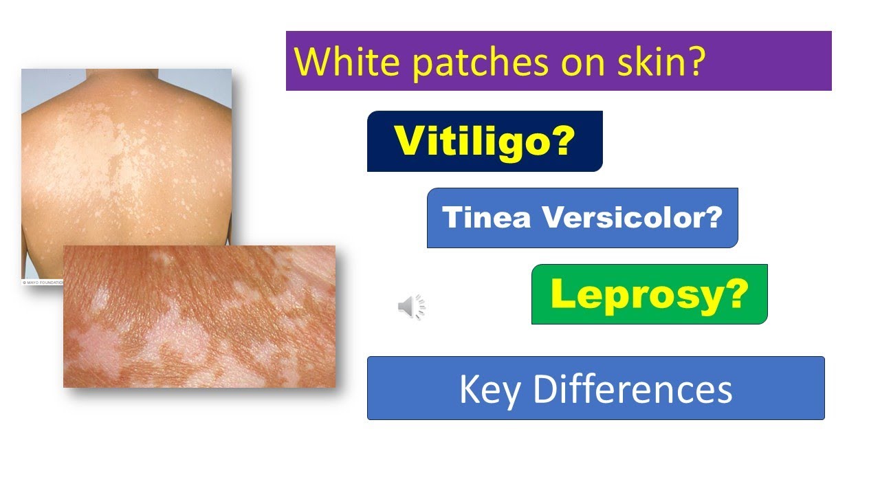 &ldquo;White Patches on Skin Explained | Vitiligo vs Tinea Versicolor vs Leprosy | Spot the Difference&rdquo;
