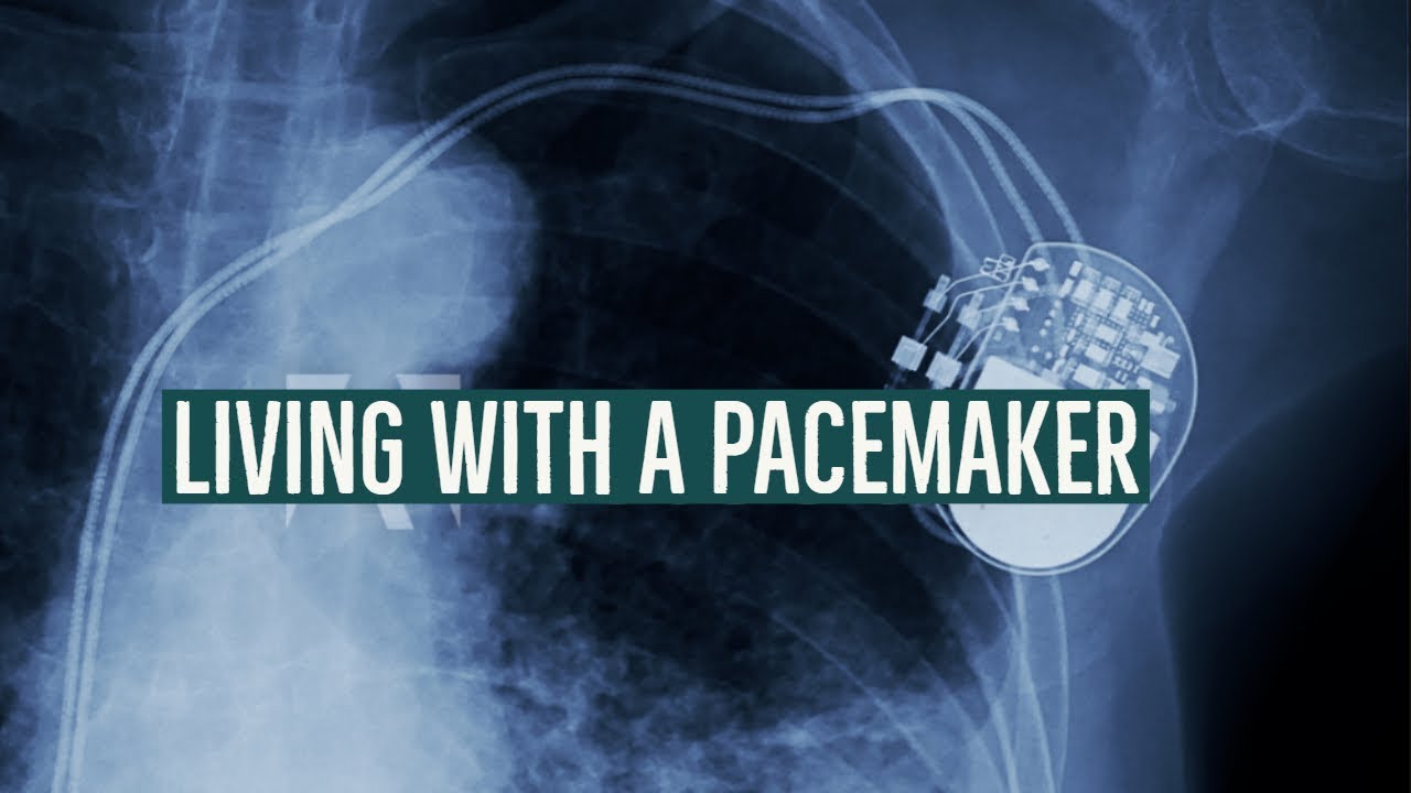 Living with a Pacemaker | Pacemaker Lead Extraction 2019