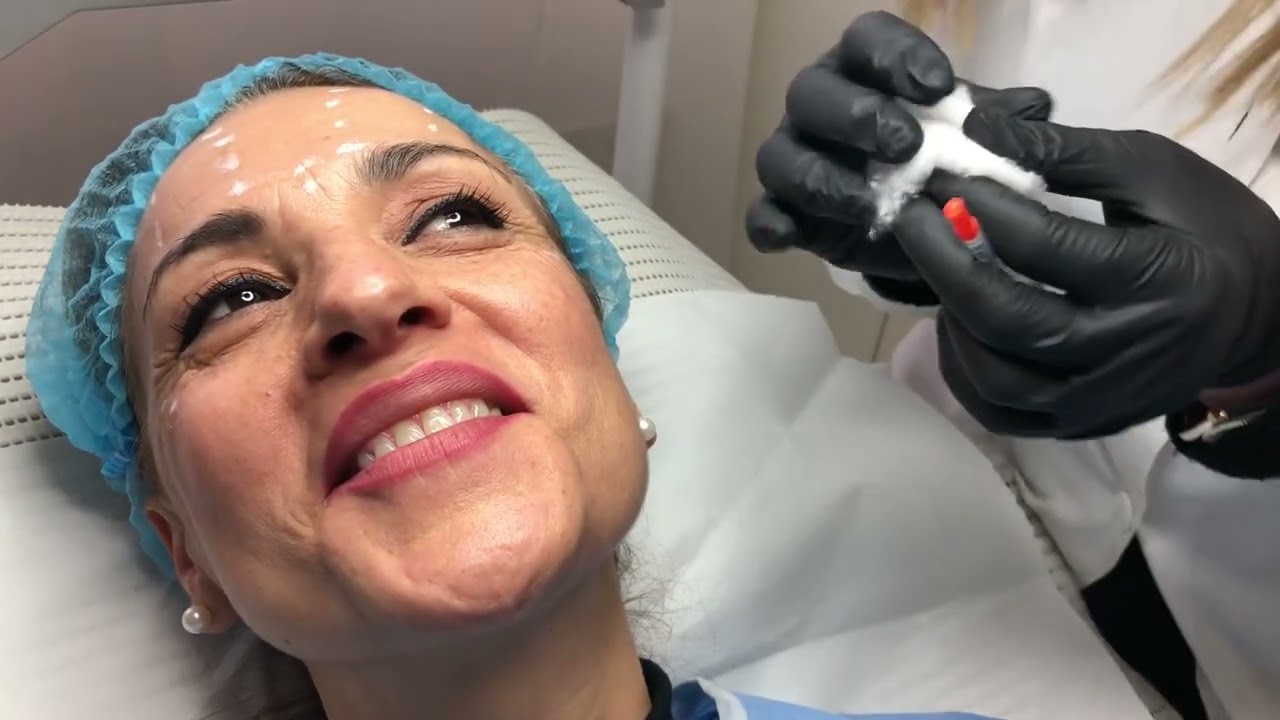 BOTOX PRIMA E DOPO: caso clinico