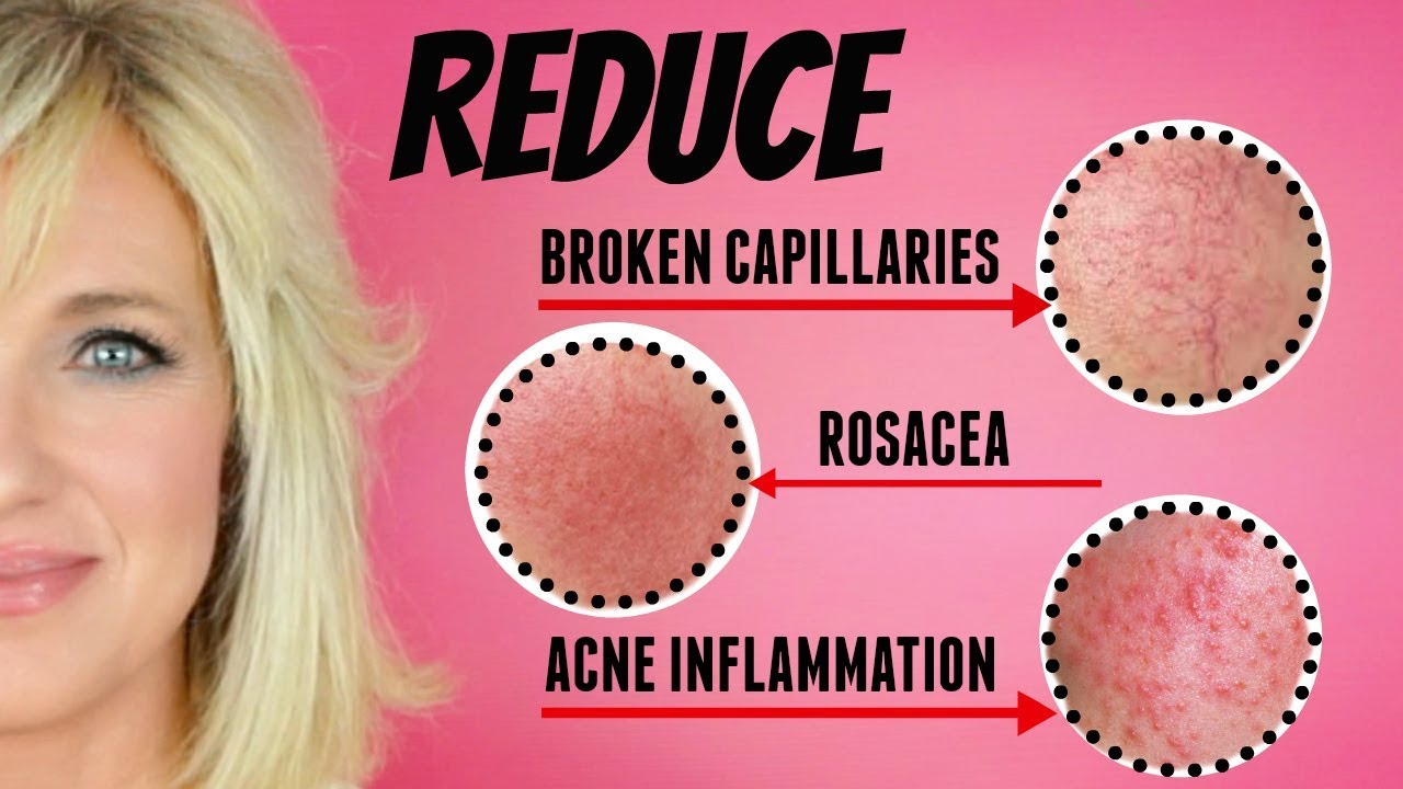 REDUCE Facial Redness, Broken Capillaries, Rosacea & Acne Inflammation!
