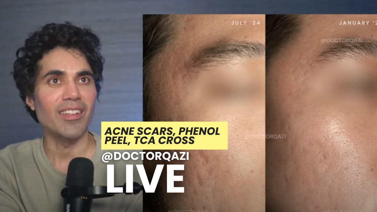 Dr. Qazi discusses Acne Scars, Phenol Peels, Lasers, TCA | Dr. Qazi Unsponsored Live | 1.9.2025