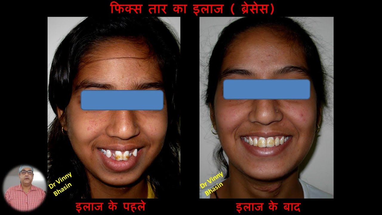 Braces Before and After  : Part 2 , Orthodontic treatment