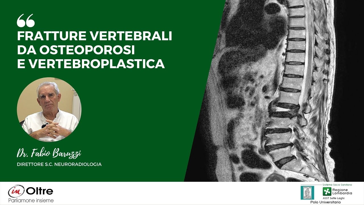 Fratture vetrebrali da osteoporosi e Vetrebroplastica