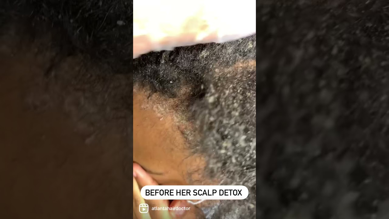 How to do a scalp detox