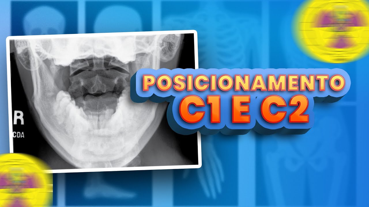 POSICIONAMENTO - C1 e C2 (AP Transoral) | Radiologando