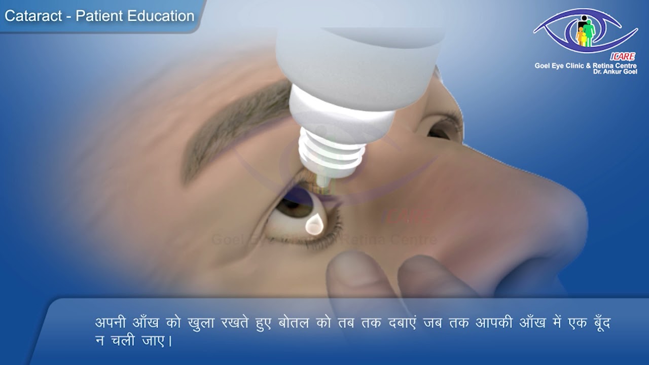 How to put Eye Drops |आई ड्रॉप कैसे डाले (मोतियाबिंद की सर्जरी के बाद) | Dr. Ankur Goel | (In Hindi)