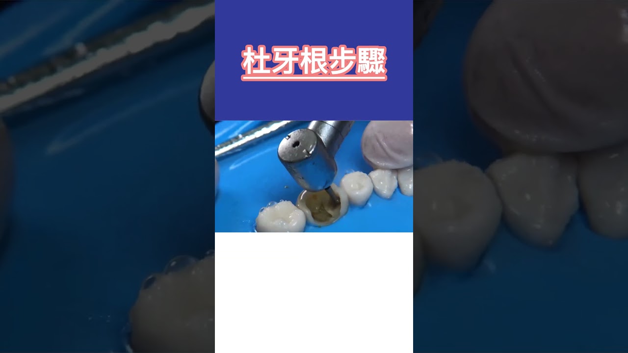 杜牙根步驟拆解，拆解牙髓治療過程