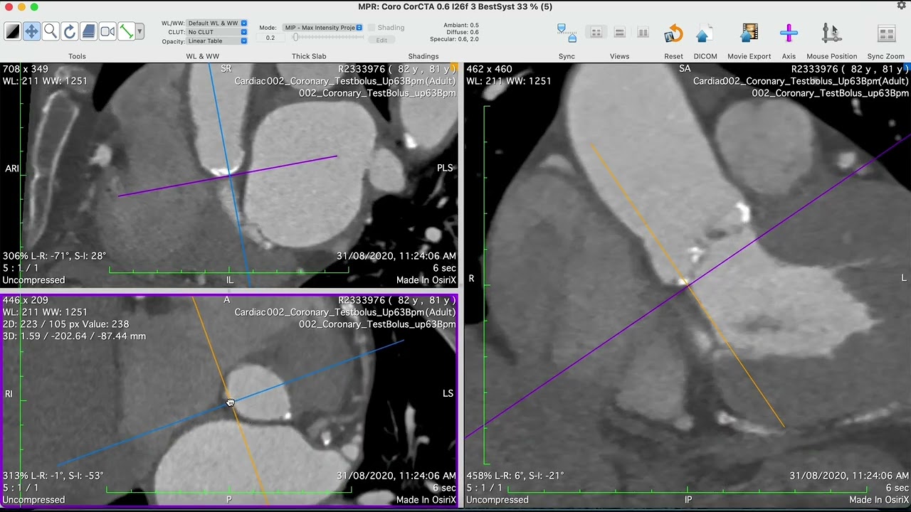 Learning TAVI: Procedure planning based on CT angiography