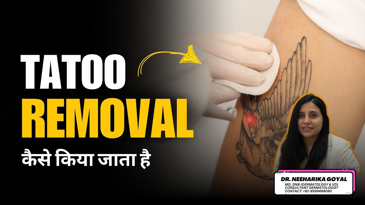 Tattoo Removal कैसे किया जाता है? | How to remove a tattoo permanently? | Dr. Neeharika Goyal