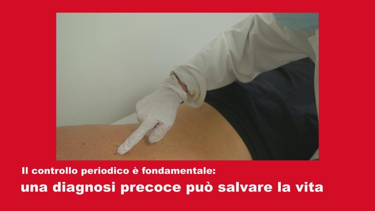 Come si fa a riconoscere un neo sospetto: cosa e dove contrallare
