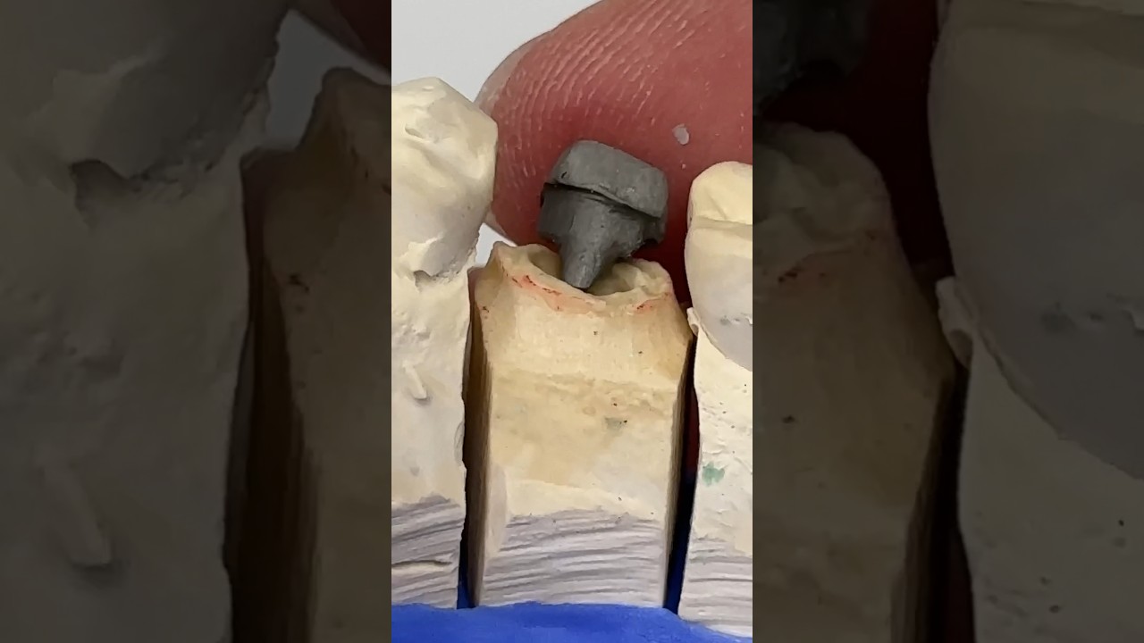 Posterior Post/Core #dental #teeth #smile #metal #shorts #shortvideo #post #core