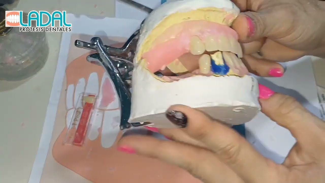 Caso Prótesis parciales acrílicas ENFILADO DENTAL VIDEO 4