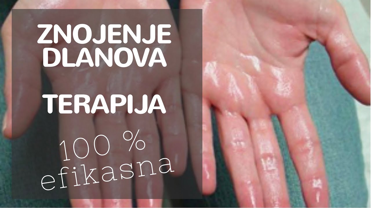 Prekomerno znojenje dlanova, botoks dlanova, lecenje znojenja, palmarna hiperhidroza