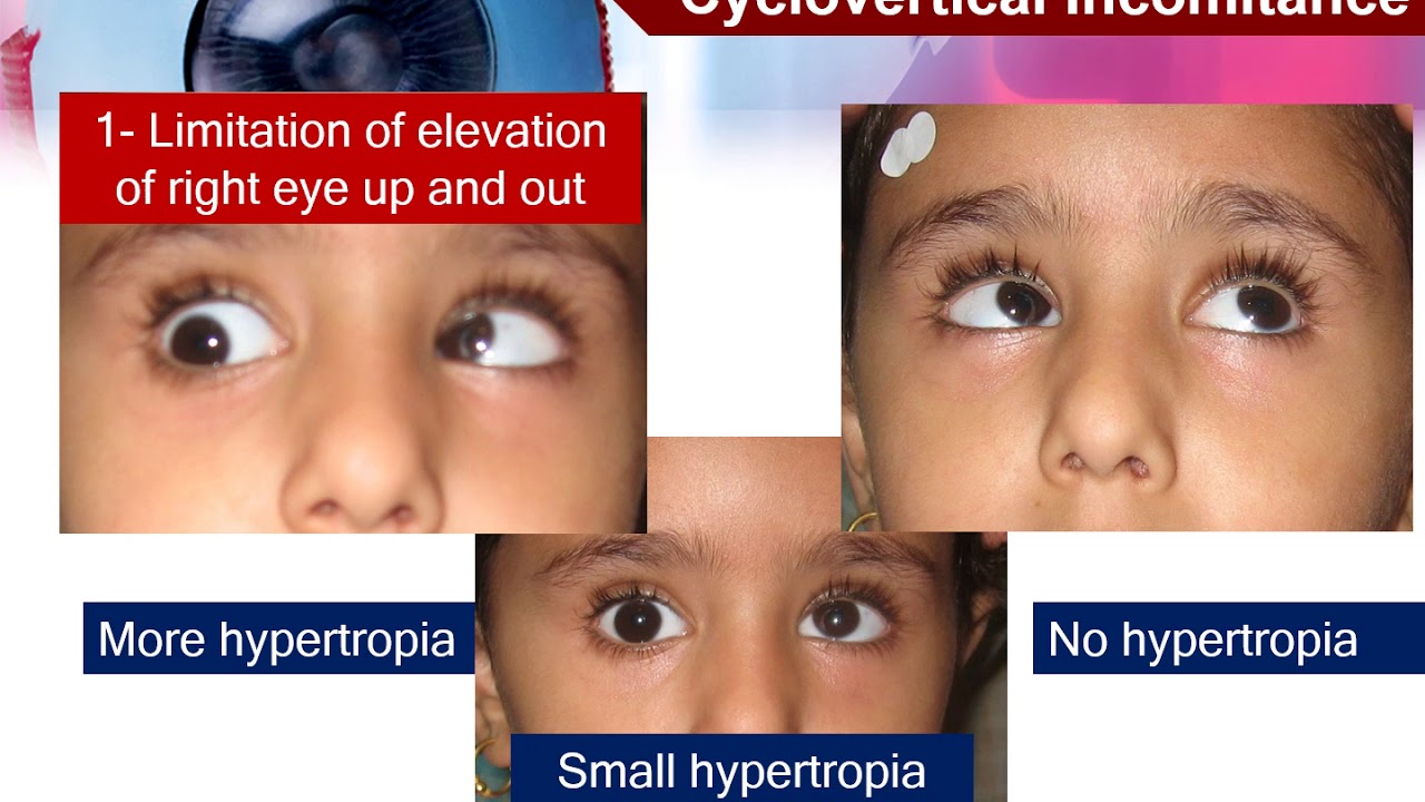 1-3 Motor evaluation of strabismus: Comitant and non-comitant strabismus