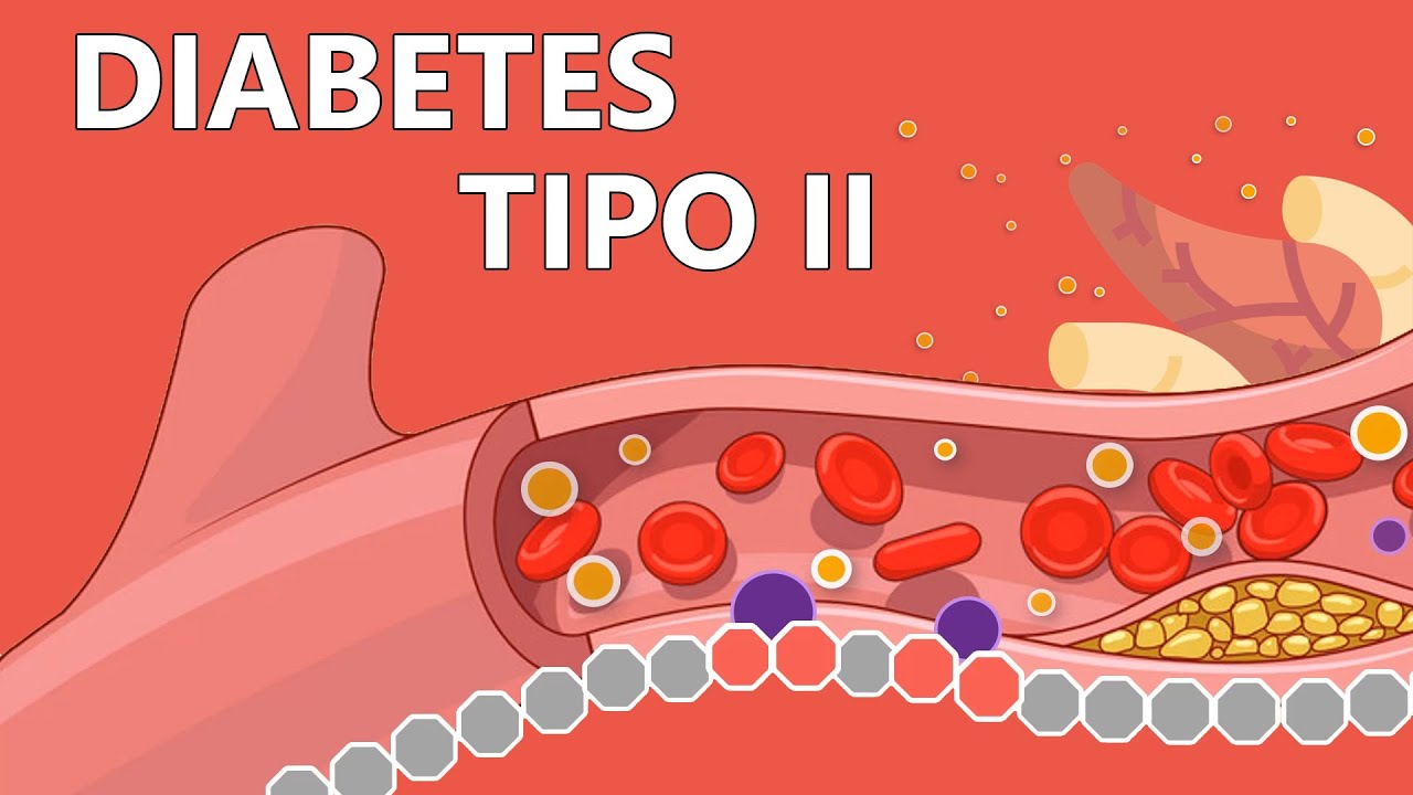 Diabetes tipo 2 - Explicada F&aacute;cilmente Para Pacientes