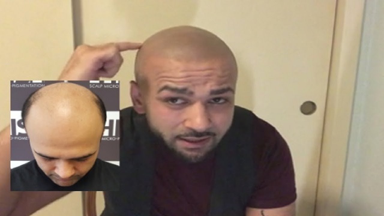 Zuber's SMP review (2 years later) Scalp Micropigmentation Houston TX Hair Tattoo | Scalpp Houston