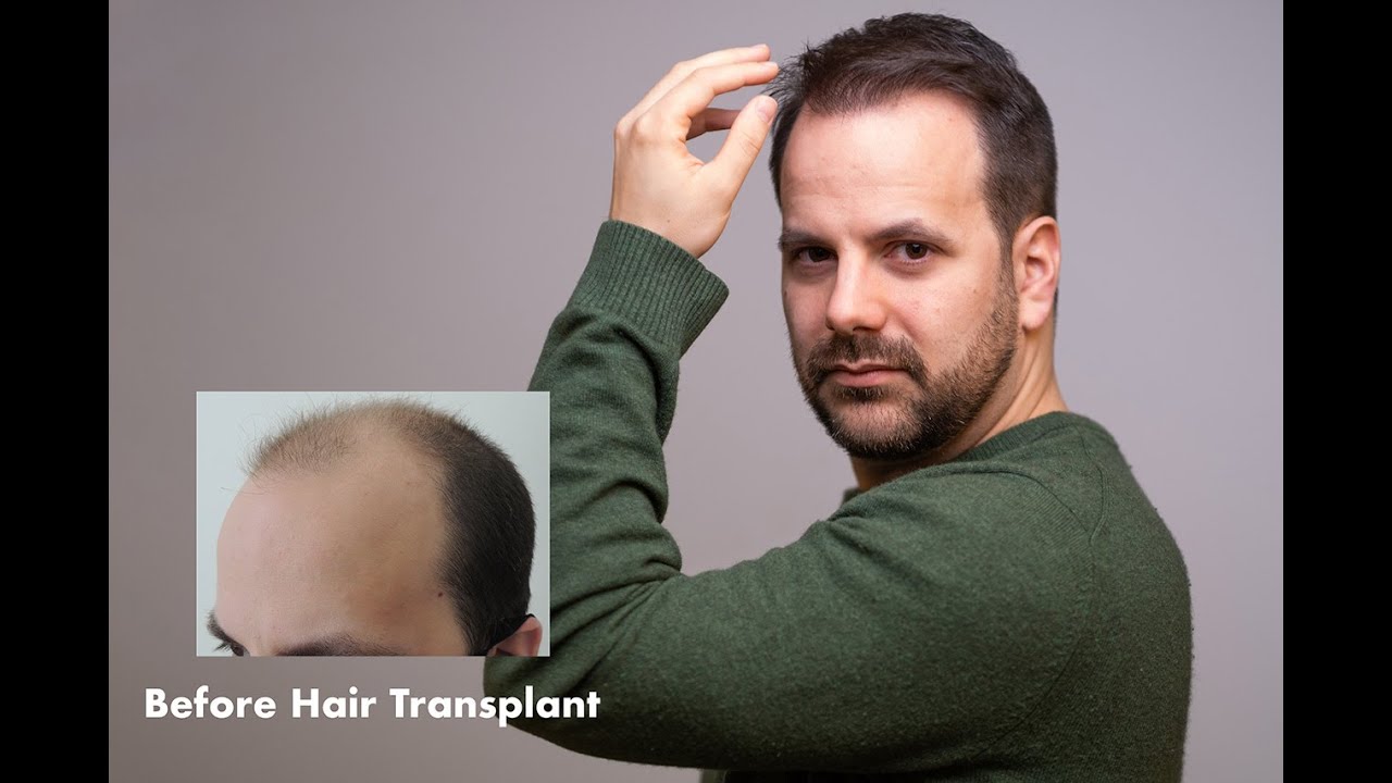 Alex Shares His Personal Hair Transplant Experience | Dr Mark Tam