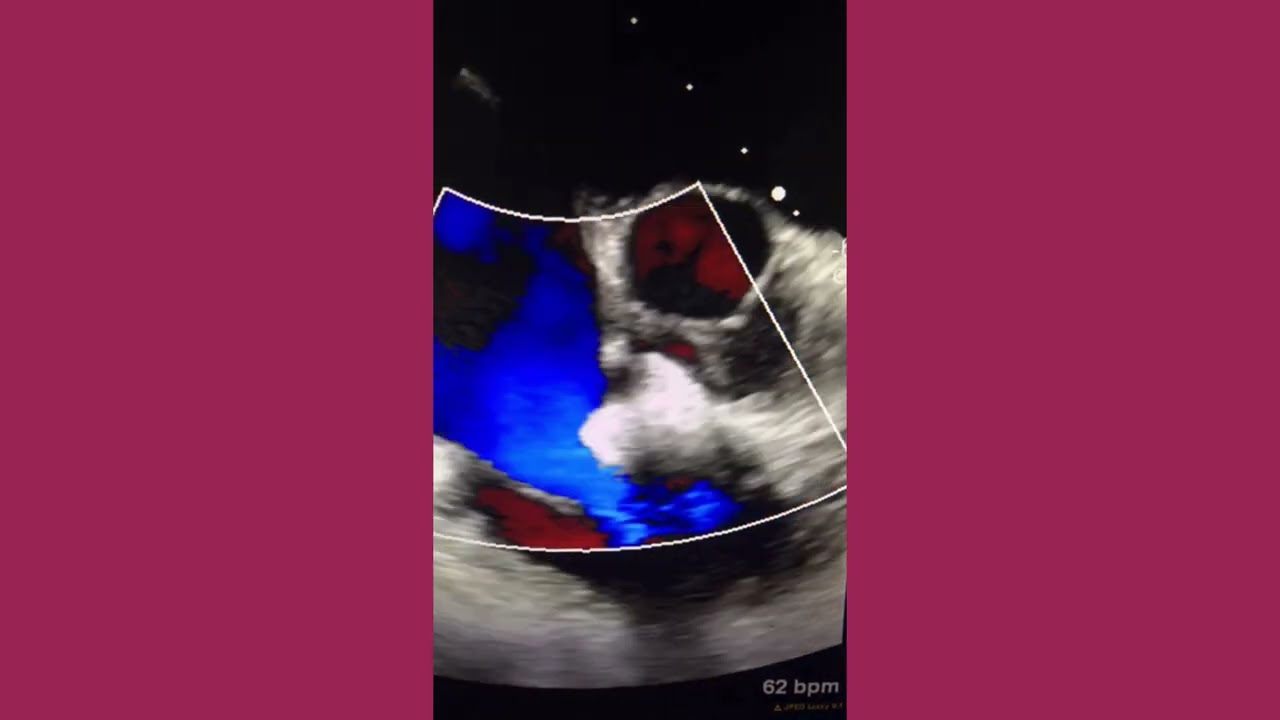 Rupture of Sinus of Valsalva (RSOV), 3D TEE Real time Deployment of a 10-8 Amplatzer Duct Occluder