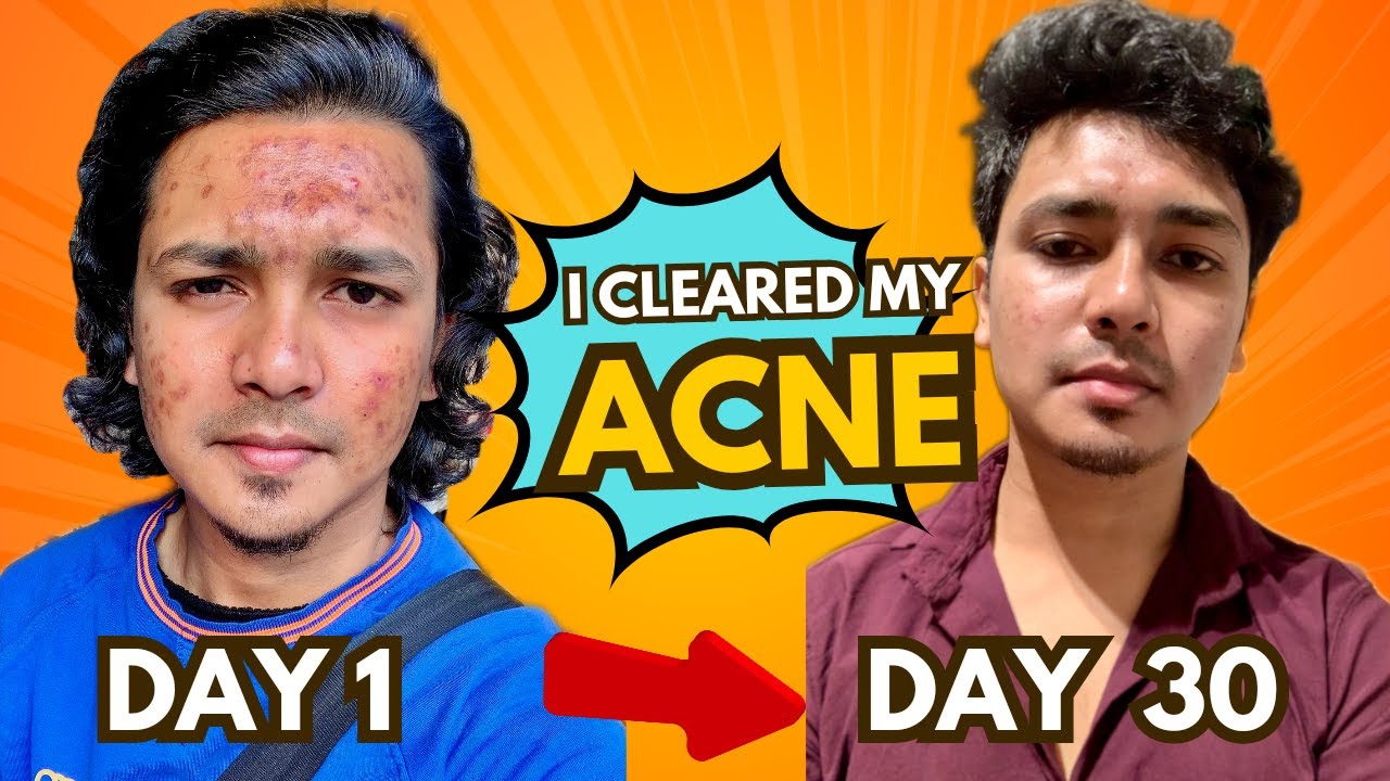 How I Cleared My Acne In 30 Days | My Acne Journey | Best Diet To Reduce Acne #acne #pimple #diet