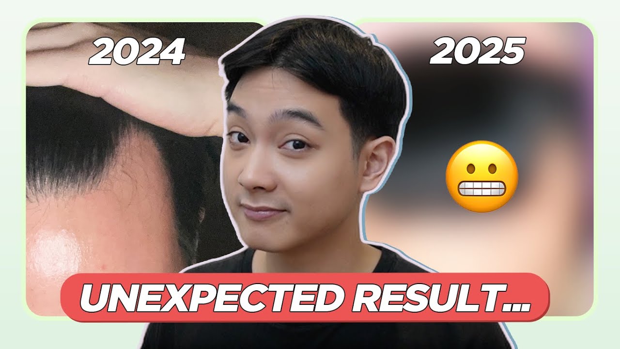 1 YEAR on HAIR LOSS TREATMENTS: Worth it ba ang MINOXIDIL and FINASTERIDE? (My Personal Journey)
