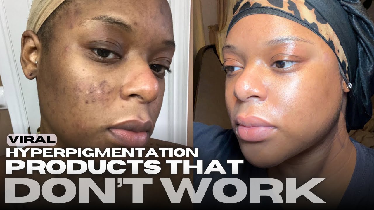 YOUR FAVORITE VIRAL HYPERPIGMENTATION PRODUCTS THAT DON’T WORK