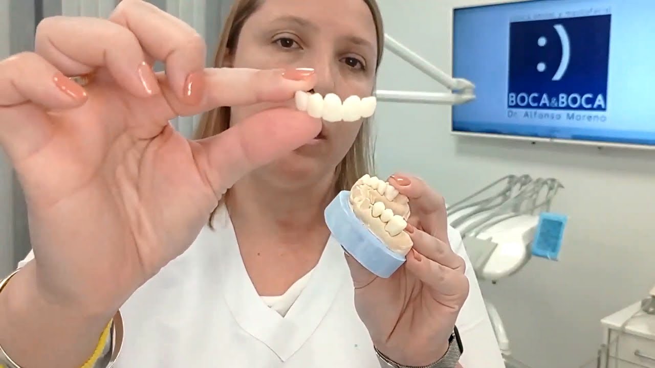 ✔️ ¿Cuál es la diferencia entre corona y carilla dental? Clínicas dentales Boca&Boca Málaga ✔️