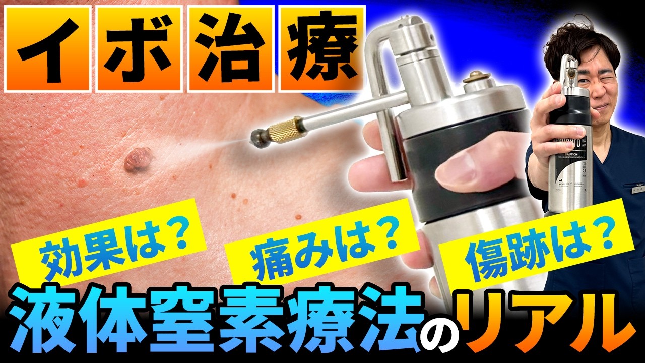 【イボ治療を皮膚科医が解説】液体窒素療法ってどんな治療？費用・痛み・回数・副作用まで！