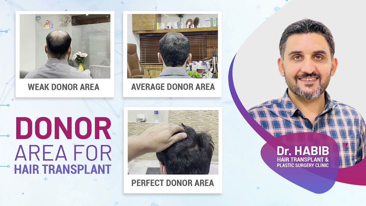 Hows your donor hair/compare your own