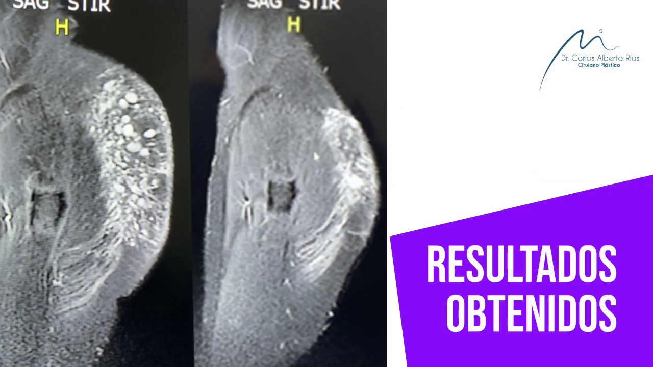 RETIRO DE BIOPOLÍMEROS EXITOSO - CASO RESONANCIA MAGNÉTICA