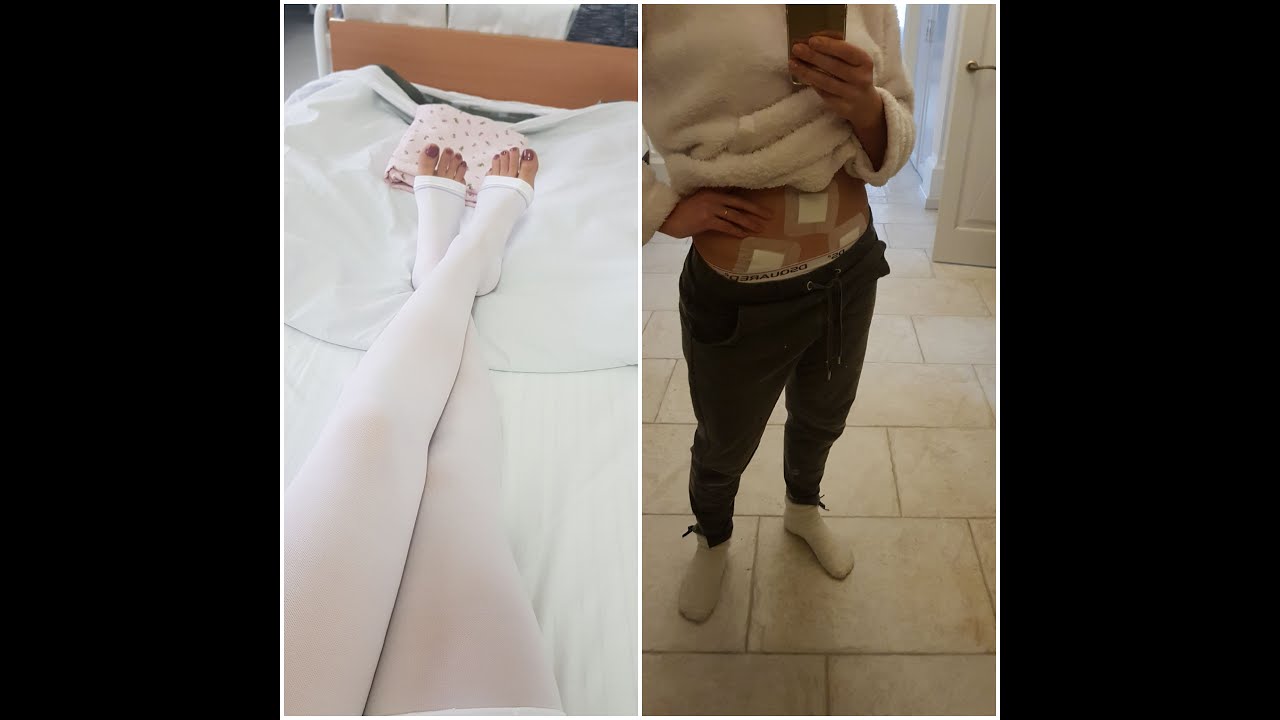 Лапароскопия. Гидросальпинкс. Моя история. Удалили трубы.