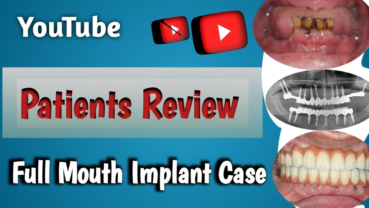 Implant Patients Review | full Mouth Implant #youtube #implants #dental #new #dentistry #smile