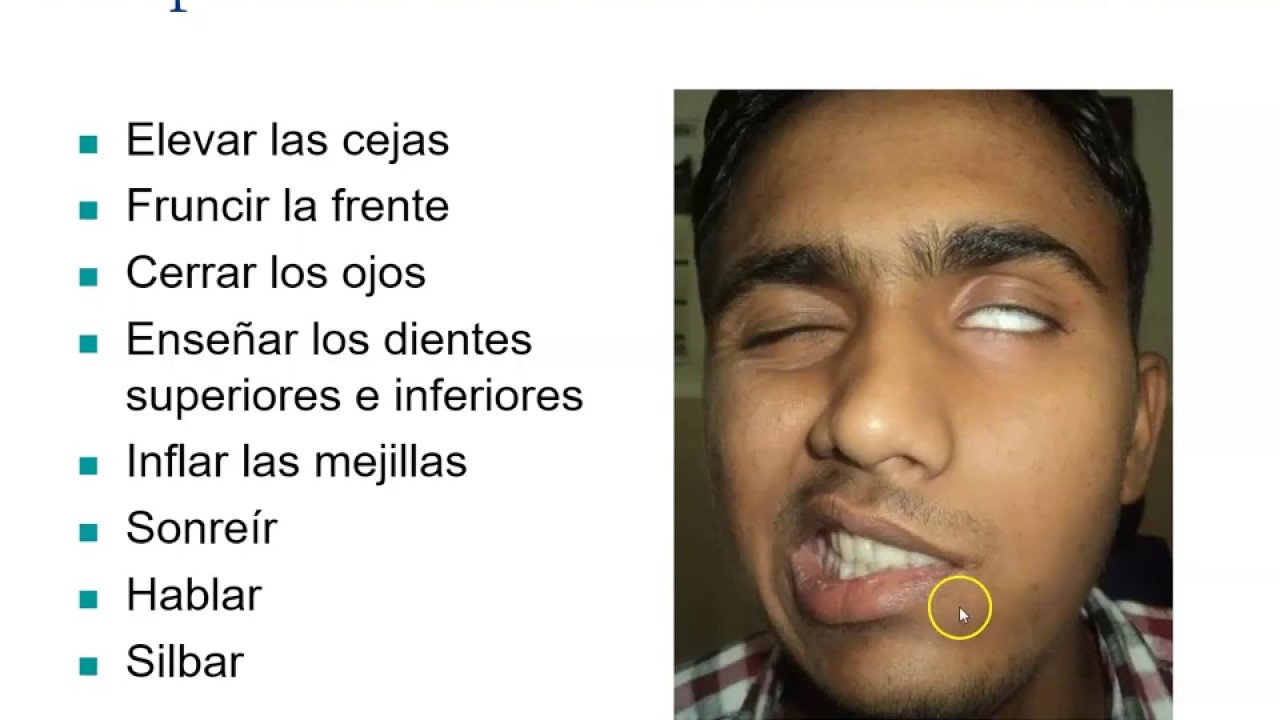 Semiología del nervio facial