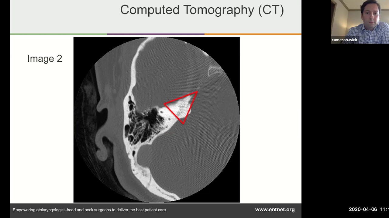 Temporal bone imaging - Dr. Cameron Wick