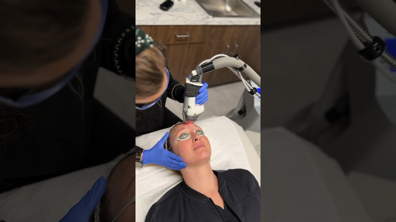 Fraxel Dual Laser - Treat Uneven Pigmentation, Acne Scarring, Sunspots, and MORE!