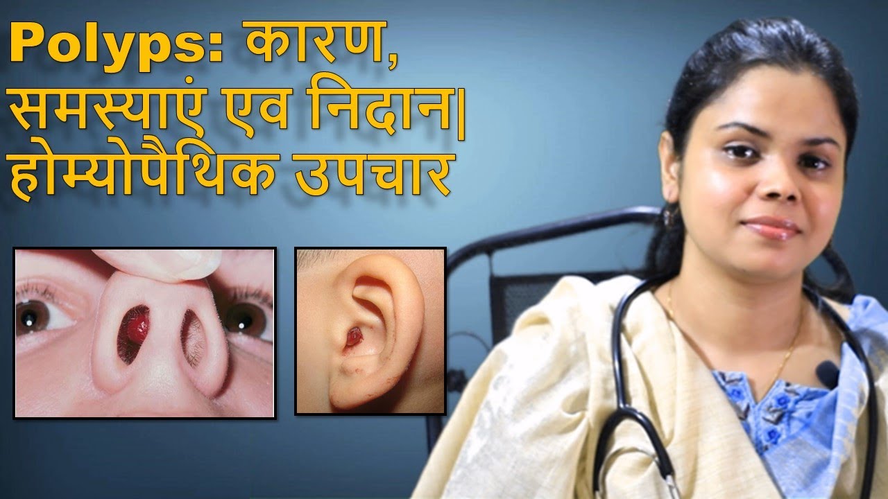 Polyps: कारण, समस्याएं एव निदान| होम्योपैथिक इलाज